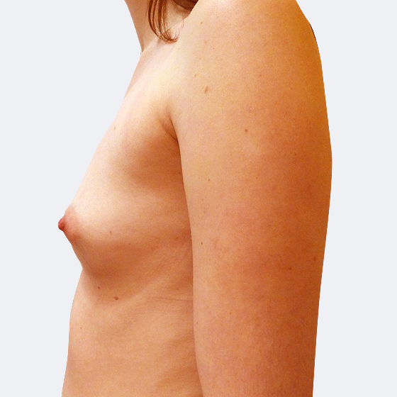 Patientin vor und nach Brustvergrößerung mit Implantaten, 27 Jahre. Es wurden runde Implantate Polytech, Größe 250 Milliliter, hohes Profil verwendet. Eingesetzt wurden durch die Unterbrustfalte teilweise unter den Muskel. Das Foto entstand zwei Monate nach der Operation.
