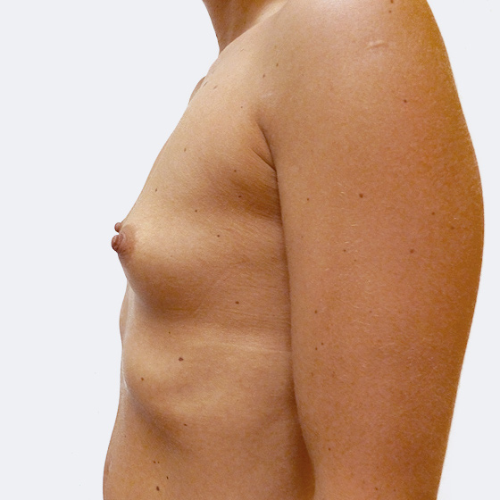 Patientin vor und nach Brustvergrößerung. Es wurden runde Implantate Eurosilicone, Größe 300 Milliliter, verwendet. Eingesetzt wurden durch die Unterbrustfalte unter den Muskel. 