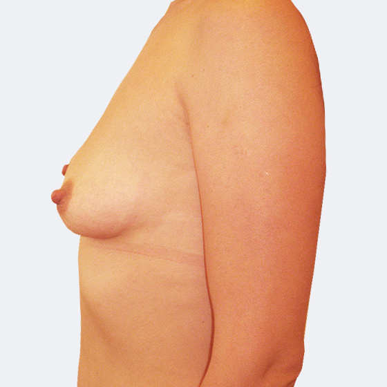 Patientin vor und nach Brustvergrößerung mit Implantaten, 39 Jahre. Es wurden Implantate Mentor, Größe 425 Milliliter, hohes Profil verwendet. Eingesetzt wurden durch die Unterbrustfalte teilweise unter den Muskel. Das Foto entstand einen Monat nach der Operation.