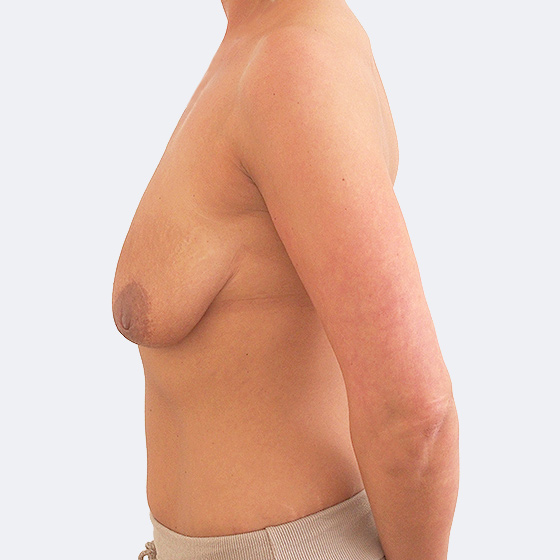 Patientin vor und nach Brustvergrößerung inklusive Straffung. Es wurden runde Implantate Polytech, Größe 360 Milliliter, hohes Profil verwendet. Das Foto entstand vier Monate nach der Operation. 