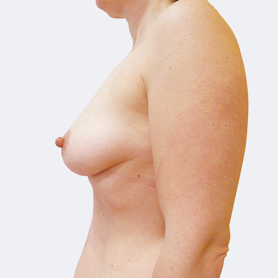 Patientin vor und nach Brustvergrößerung inklusive Straffung. Es wurden runde Implantate Polytech, Größe 195 Milliliter, mittleres Profil verwendet. Das Foto entstand zwei Monate nach der Operation. 