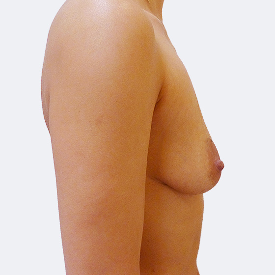 Patientin vor und nach Brustvergrößerung inklusive Straffung. Es wurden runde Implantate Polytech, Größe 360 Milliliter, hohes Profil verwendet. Das Foto entstand drei Monate nach der Operation. 