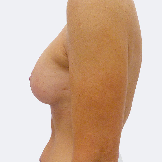 Patientin vor und nach Brustvergrößerung inklusive Straffung. Es wurden runde Implantate Polytech, Größe 220 Milliliter, mittleres Profil verwendet. Das Foto entstand zwei Monate nach der Operation. 