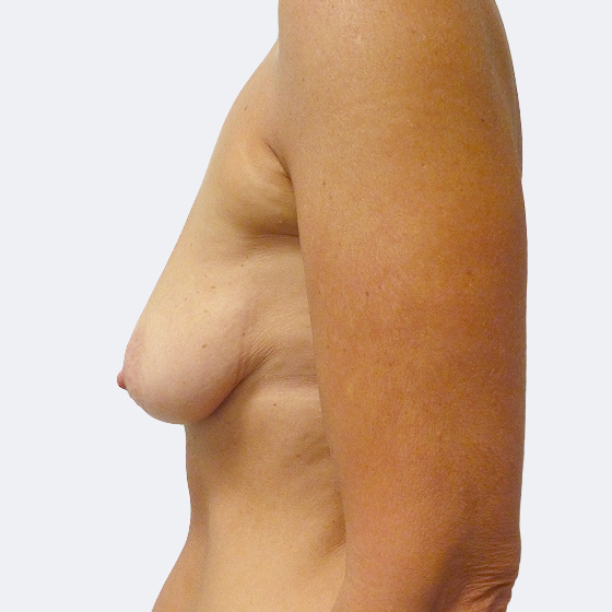Patientin vor und nach Brustvergrößerung inklusive Straffung. Es wurden runde Implantate Polytech, Größe 220 Milliliter, mittleres Profil verwendet. Das Foto entstand zwei Monate nach der Operation. 
