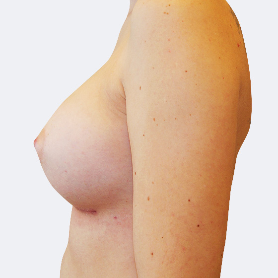 Patientin vor und nach Brustvergrößerung. Es wurden runde Implantate Mentor, Größe 350 Milliliter, hohes Profil verwendet. Eingesetzt wurden durch die Unterbrustfalte unter den Muskel. Das Foto entstand einen Monat nach dem Eingriff. 