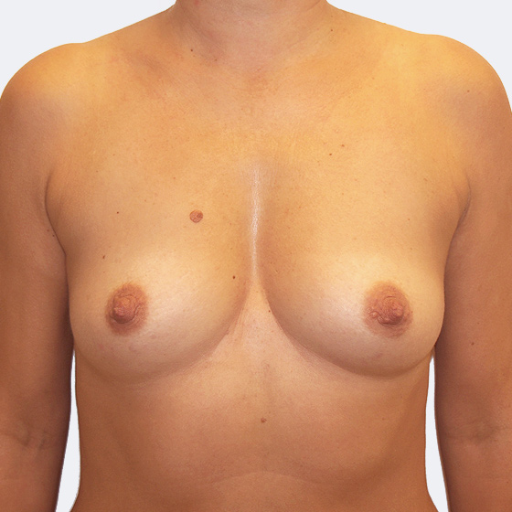 Patientin vor und nach Brustvergrößerung. Es wurden runde Implantate Mentor, Größe 400 Milliliter, verwendet. Eingesetzt wurden durch die Unterbrustfalte unter den Muskel. 