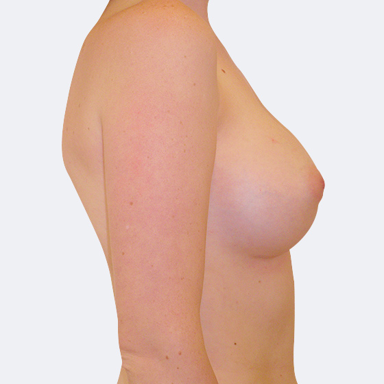 Patientin vor und nach Brustvergrößerung mit Implantaten, 30 Jahre. Es wurden runde Implantate Mentor, Größe 300 Milliliter, mittleres Profil +, verwendet. Eingesetzt wurden durch die Unterbrustfalte teilweise unter den Muskel. Das Foto entstand drei Wochen nach der Operation.