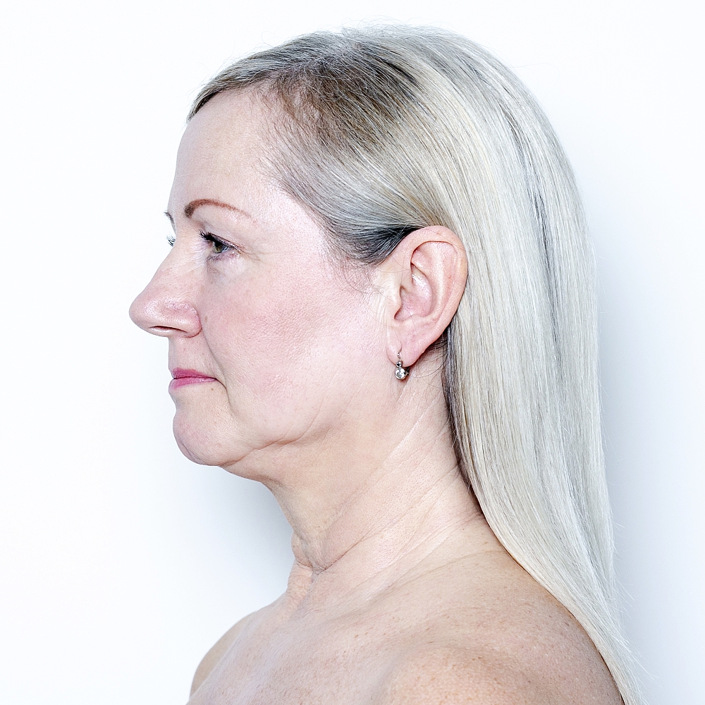 Patientin (56) vor und nach Gesichtsverjüngung MyFaceLift. Die Operation wurde in Lokalanästhesie durchgeführt. Das Foto entstand 3 Wochen nach der Operation.  