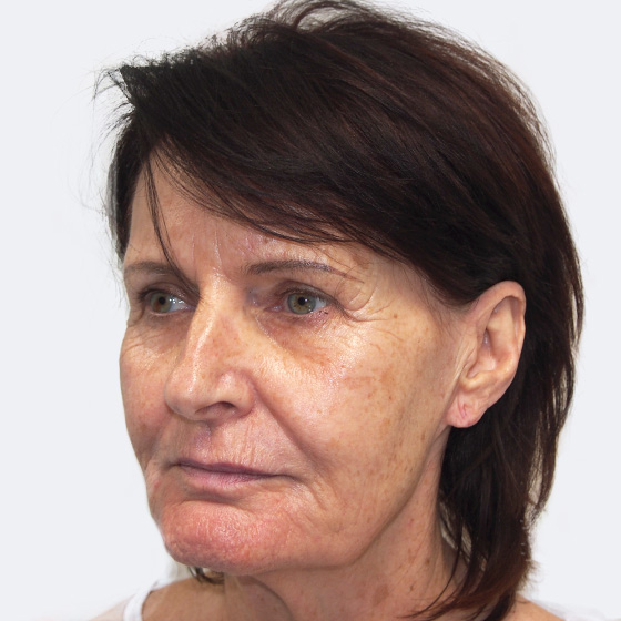 Patientin (65) vor und nach Gesichtsverjüngung MyFaceLift. Die Operation wurde in Lokalanästhesie durchgeführt. Das Foto entstand 3 Wochen nach der Operation.  